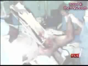 Wood Penetrates Mans Chest